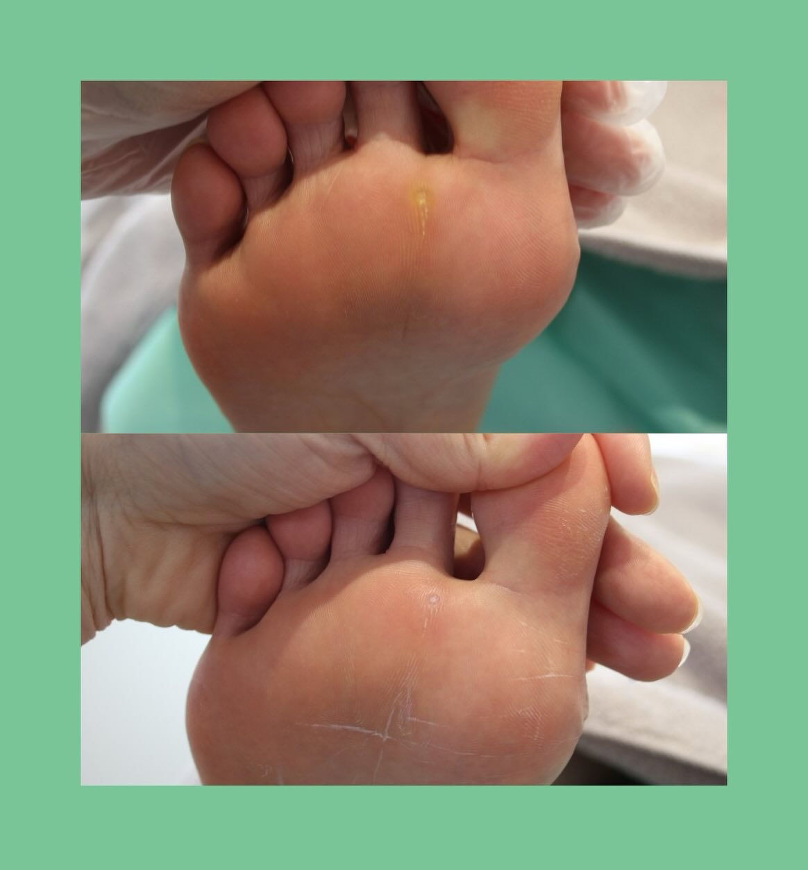 ウオノメケア完了👣✨