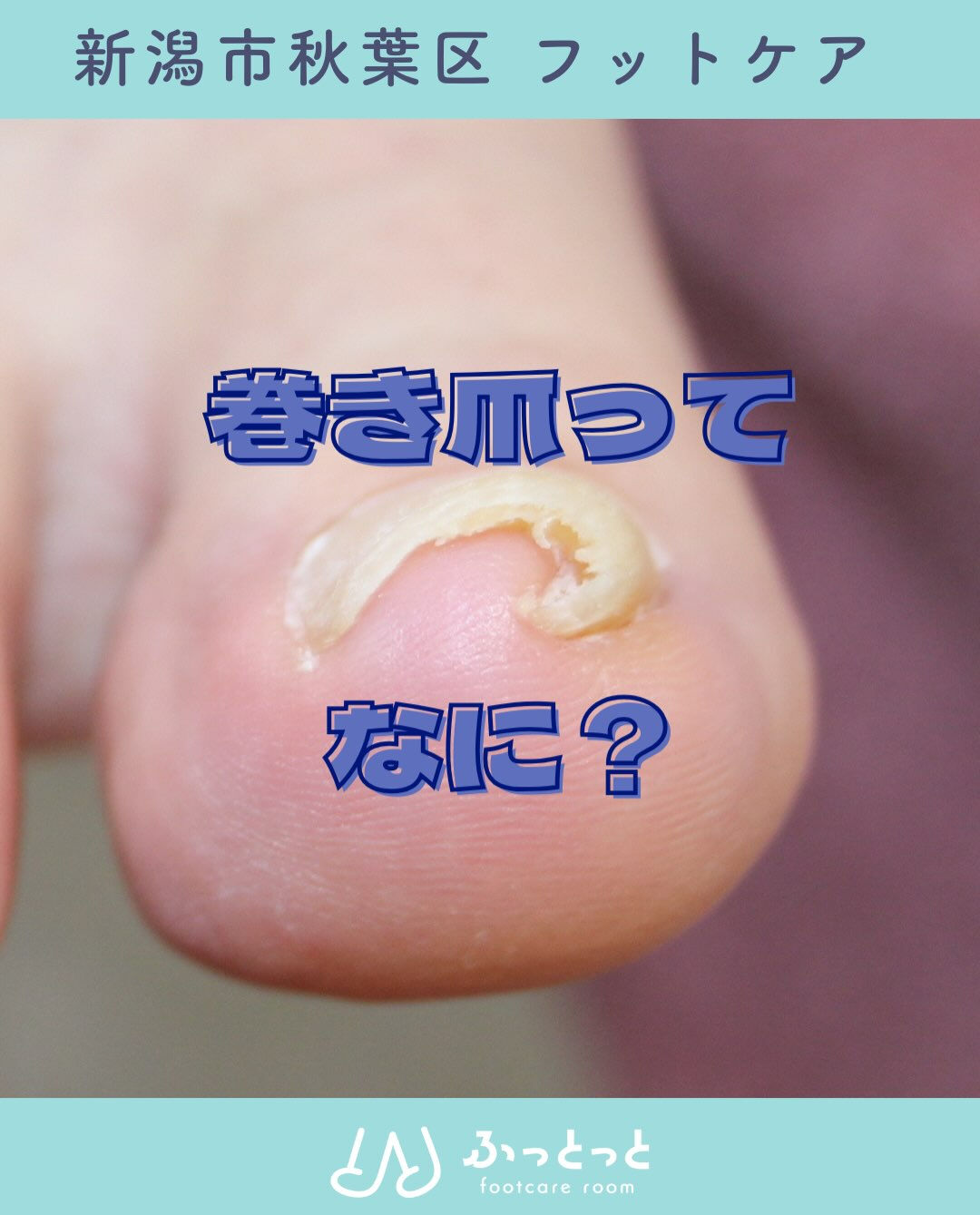 巻き爪ってなに？