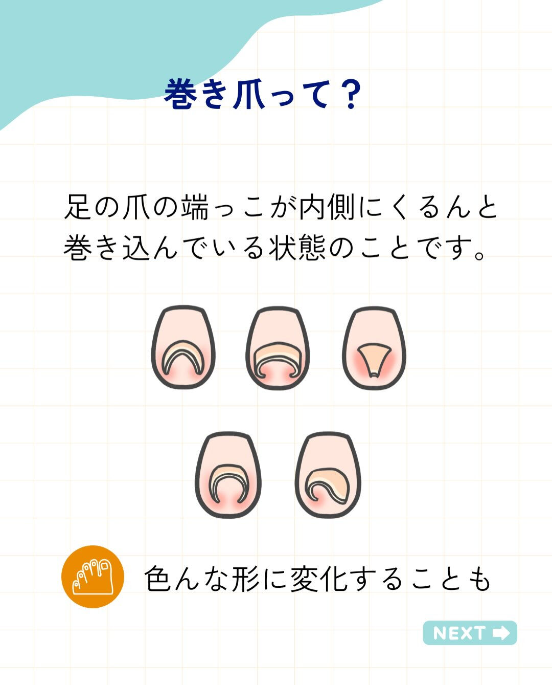 巻き爪ってなに？